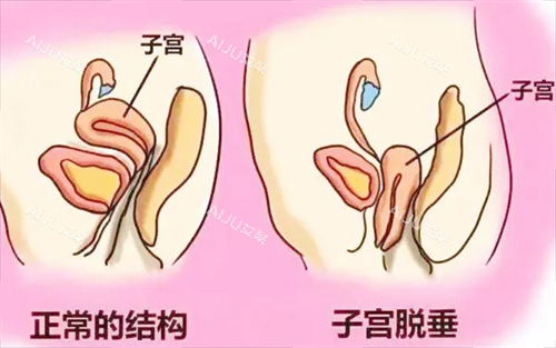 子宫脱垂对比