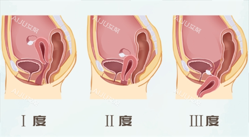 子宫脱垂一二三度对比图