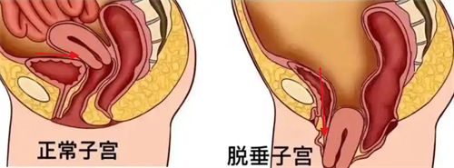 子宫脱垂前后对比
