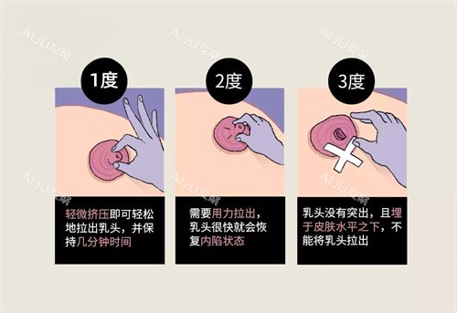 乳头内陷按摩方式图