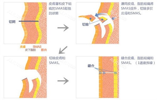 齐齐哈尔君悦筋膜悬吊手术