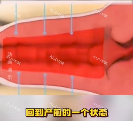 女性私密收紧针照片