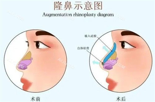 隆鼻前后对比