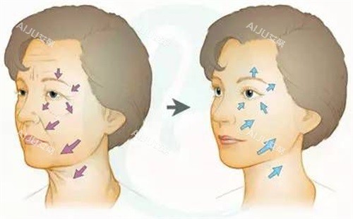 面部筋膜除皱对比图