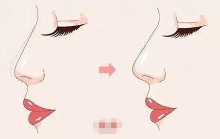 鼻梁鼻尖抬高前后对比图 鼻梁鼻尖抬高前后对比图