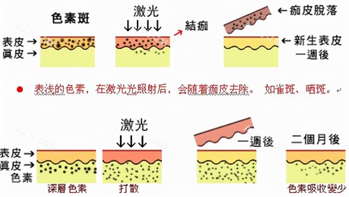 激光祛斑过程