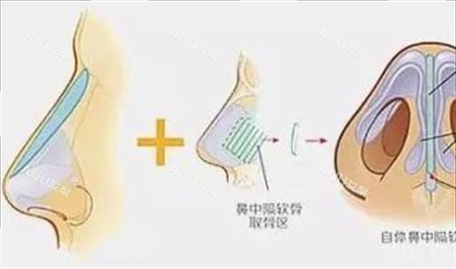 周顺波医生鼻子整形实力解析，娴熟技术塑造理想鼻型&求美者满意度普遍高