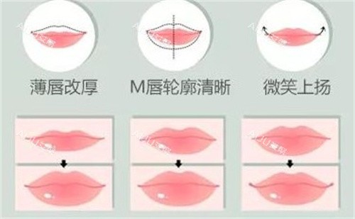 嘴唇整形手术