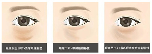 眼底脂肪重排对比