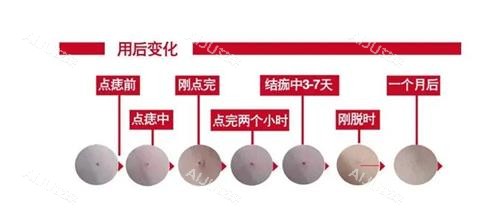 激光去痣后的成效