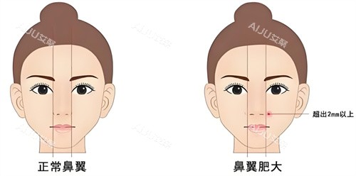 鼻翼缩小异常图