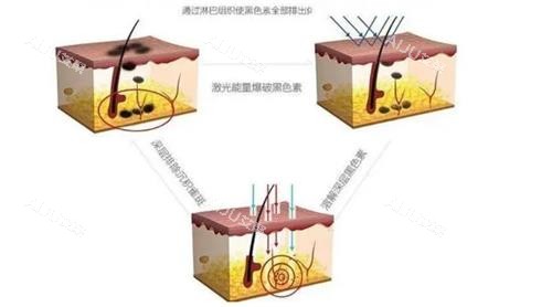 激光去痣原理