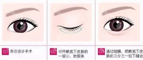 卧蚕手术步骤