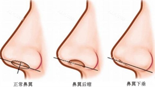 不同鼻翼对比