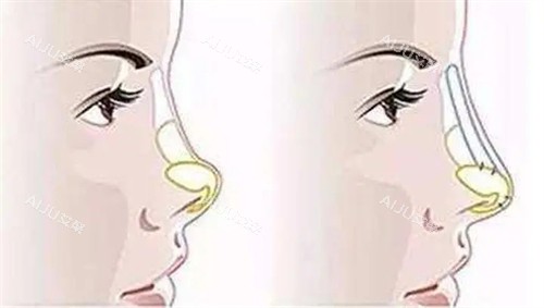 朝天鼻填充假体