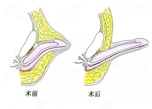 ADM-H内置生物套手术示意图