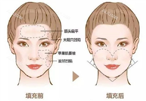 自体脂肪填充前后对比图