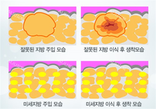 自体脂肪填充术后脂肪细胞前后对比