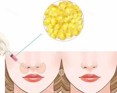 脂肪填充鼻基底位置示意图