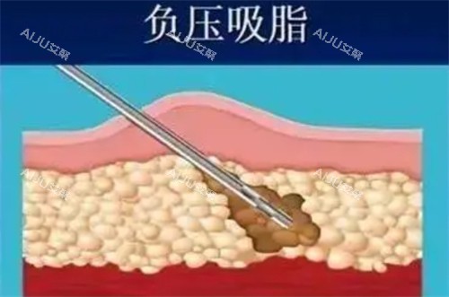 负压吸脂