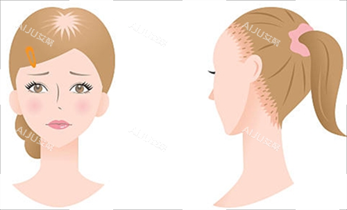 女生脱发类型