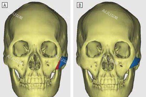 颧骨内推示意图