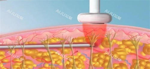 射频溶脂 射频溶脂