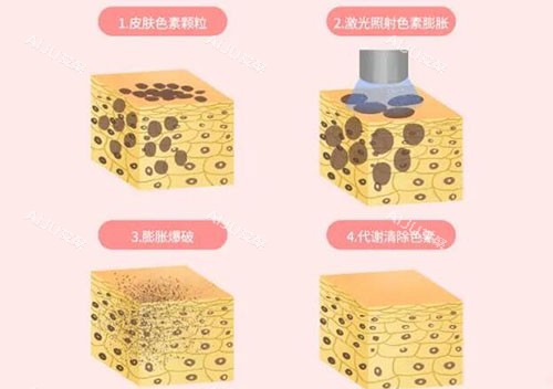 超皮秒皮肤改善原理 超皮秒皮肤改善原理