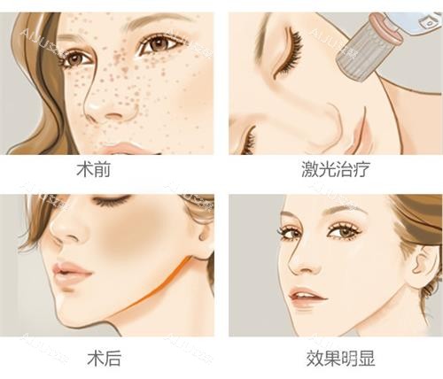 激光祛斑的过程 激光祛斑的过程