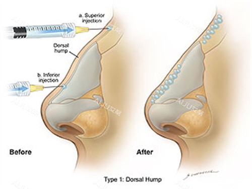 玻尿酸注射手术过程 玻尿酸注射手术过程