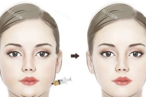 面部吸脂对比 面部吸脂对比