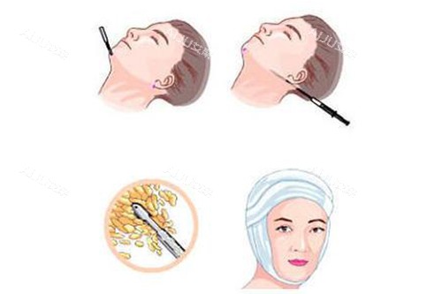 面部吸脂过程示意图 面部吸脂过程示意图