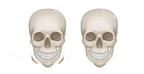 下颏整形卡通示意图 下颏整形卡通示意图