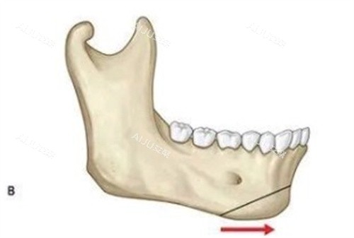 颏成型术 颏成型术