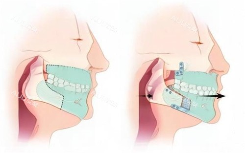 颏成形术动画演示图 颏成形术动画演示图