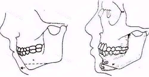 颏成形术手术过程 颏成形术手术过程
