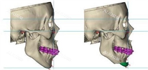 颏成型手术 颏成型手术