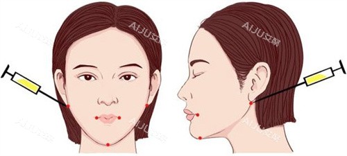 注射点位 注射点位