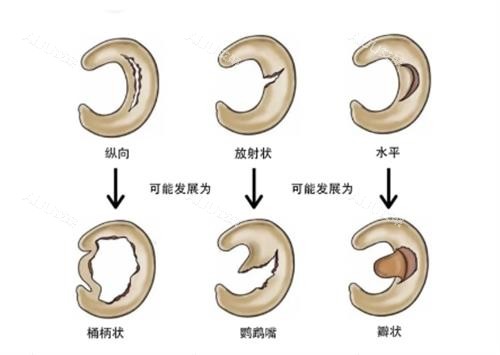 半月板损伤的后果