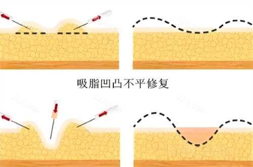 商洛东方韵美吸脂术后皮肤凹凸不平