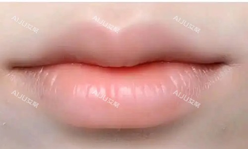 微笑唇术后成效图