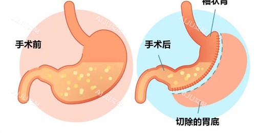 袖状胃切除手术前后对比卡通