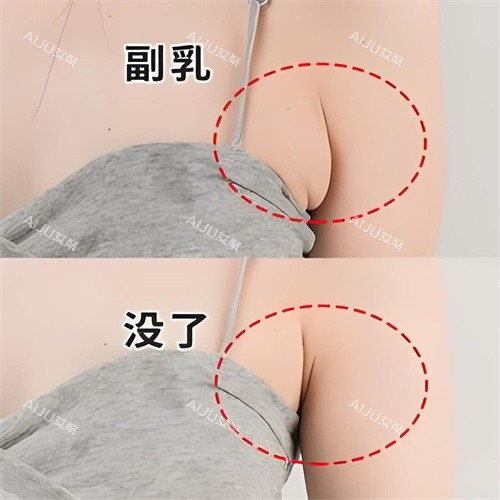 去副乳手术前后对比演示图