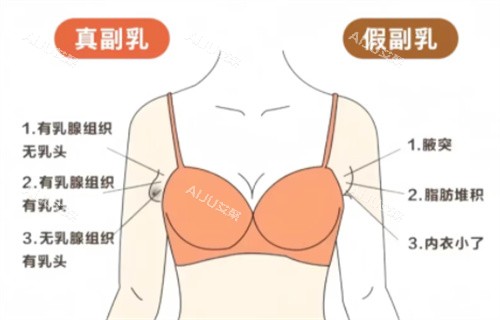 真假性副乳对比