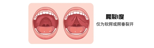 一度唇腭裂