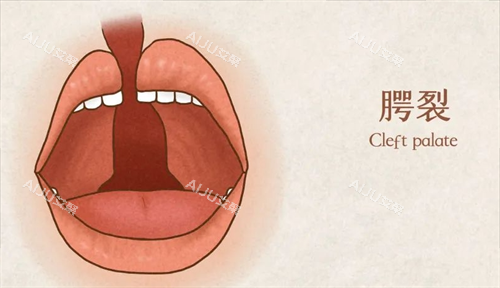 唇腭裂口内的动画展示