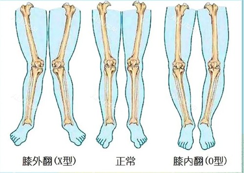 不同腿型对比动画演示