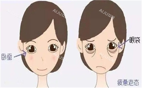 卧蚕手术对比