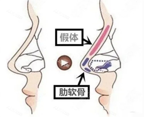 隆鼻示意图