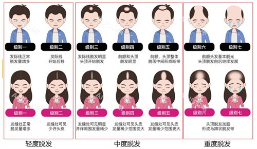 不同程度的脂溢性脱发